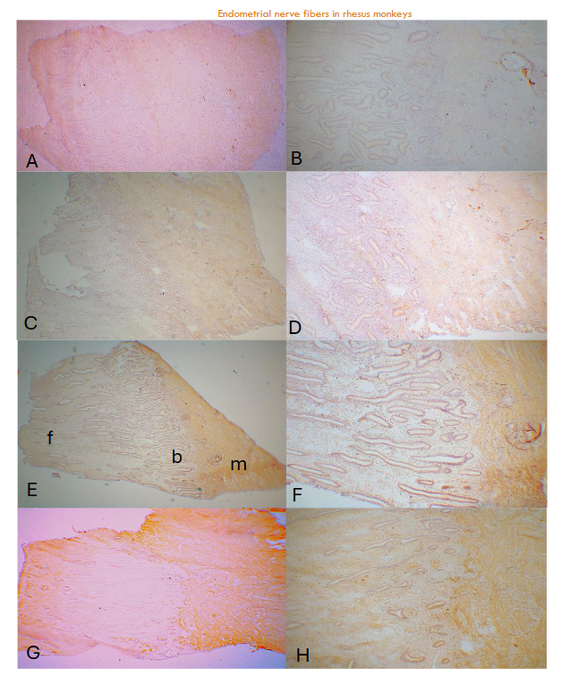 Figure 2: Day 14 (E-14p) after removal of P and Day 21 (E+7p) 7 days placing P Day 14 functionalis was more elongated (1,700 ± 58µm) containing several nonmyelinated nerve fibers with a few myelinated nerve fibers at the basalis-myometrium interphase and diffusely distributed nonmyelinated nerve fibers and one myelinated nerve fiber in the myometrium using NF (A-low power, B-high power) and slightly more nerve fibers revealed using CD56 (C-low power, D-high power). Day 21 functionalis was slightly more elongated (1,800 ± 147µm) containing several nonmyelinated nerve fibers at the basalis-myometrium interphase and diffusely distributed fine nonmyelinated nerve fibers in the myometrium using NF (C-low power, D-high power) and slightly more nerve fibers using CD56 (E-low power, F-high power).