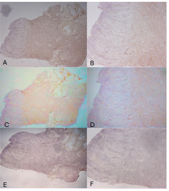 Figure 4: Uterus Spayed for 5 Months In the spayed uterus, the basalis was thickened (500 to 700µm) and there were diffusely distributed fine vertical nonmyelinated nerve fibers immunostained using both NF (A-low power, B-high power) and CD56 (C-low power, D-high power) but not immunostained using PGP9.5 (E-low power, F-high power). And B:NF, C and D: CD56, E and F: PGP9.5 immunostained