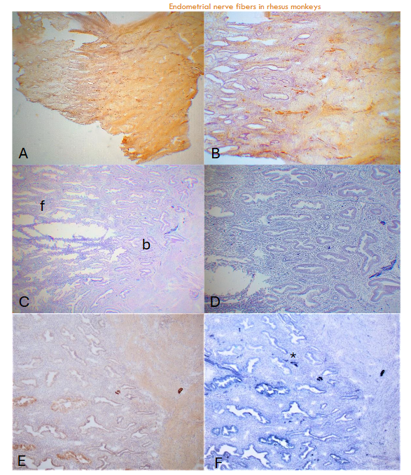 Figure 3: Day 28 (E + 14P) 14 days placing P Day 28 specimen was cut at 25µm in thickness to reveal more nerve fibers using CD56. The functionalis was the longest (2,225 ± 13µm) and there were thick, darkly stained nerve nonmyelinated nerve fibers at the basalis-myometrium interphase and deep basalis using CD56 (A-low power, B-high power). In the 10µm sections with alkaline phosphatase method, one nonmyelinated nerve fiber (*) and one myelinated nerve fiber was at the basalis-myometrium interphase and another myelinated nerve fiber was in the myometrium using NF (C-low power, D-high power). To compare the immunostaining between peroxidase method and alkaline phosphatase method using NF, both methods revealed myelinated nerve fibers (E-peroxidase, F-alkaline phosphatase) and only alkaline phosphatase method revealed one nonmyelinated nerve fiber (*)(F).