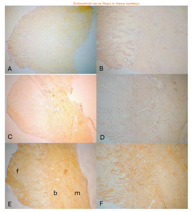 Figure 1: Day 3 (E - 3P) and Day 7 (E -7p) after removal of P In Day 3 endometrium, there were sloughed off thin remnants of basalis (438 ± 38µm) with few fine nerve fibers using CD56 while there were consistently distributed fine nonmyelinated nerve fibers in the myometrium (A-low power, B-high power). In Day 7, there were functionalis (1,240 ± 103µm) and several nonmyelinated nerve fibers at the basalis-myometrium interphase as well as scattered fine nerve fibers in the myometrium. (C-low power, D-high power) using NF. Similar nerve fibers were revealed at the basalis-myometrium interphase and myometrium using PGP9.5. (E-low power, F-high power) b:basalis, f:functionalis, m:myometrium A and B: CD56, C and D:NF, E and F: PGP9.5 immunostained
