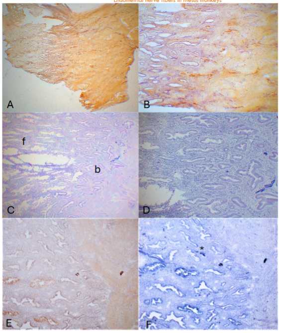 Figure 3: Day 28 (E + 14P) 14 days placing P Day 28 specimen was cut at 25µm in thickness to reveal more nerve fibers using CD56. The functionalis was the longest (2,225 ± 13µm) and there were thick, darkly stained nerve nonmyelinated nerve fibers at the basalis-myometrium interphase and deep basalis using CD56 (A-low power, B-high power). In the 10µm sections with alkaline phosphatase method, one nonmyelinated nerve fiber (*) and one myelinated nerve fiber was at the basalis-myometrium interphase and another myelinated nerve fiber was in the myometrium using NF (C-low power, D-high power). To compare the immunostaining between peroxidase method and alkaline phosphatase method using NF, both methods revealed myelinated nerve fibers (E-peroxidase, F-alkaline phosphatase) and only alkaline phosphatase method revealed one nonmyelinated nerve fiber (*)(F).
