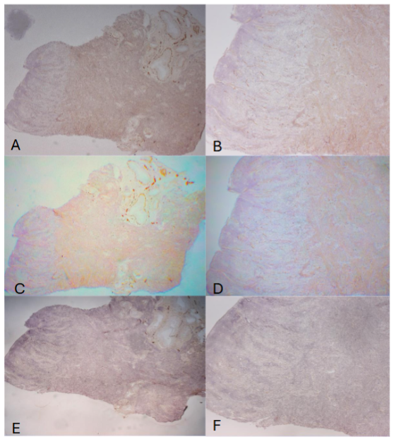 Figure 4: Uterus Spayed for 5 Months In the spayed uterus, the basalis was thickened (500 to 700µm) and there were diffusely distributed fine vertical nonmyelinated nerve fibers immunostained using both NF (A-low power, B-high power) and CD56 (C-low power, D-high power) but not immunostained using PGP9.5 (E-low power, F-high power). And B:NF, C and D: CD56, E and F: PGP9.5 immunostained.