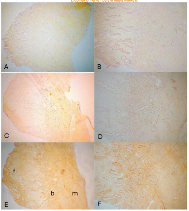 Figure 1: Day 3 (E - 3P) and Day 7 (E -7p) after removal of P. In Day 3 endometrium, there were sloughed off thin remnants of basalis (438 ± 38µm) with few fine nerve fibers using CD56 while there were consistently distributed fine nonmyelinated nerve fibers in the myometrium (A-low power, B-high power). In Day 7, there were functionalis (1,240 ± 103µm) and several nonmyelinated nerve fibers at the basalis-myometrium interphase as well as scattered fine nerve fibers in the myometrium. (C-low power, D-high power) using NF. Similar nerve fibers were revealed at the basalis-myometrium interphase and myometrium using PGP9.5. (E-low power, F-high power) b:basalis, f:functionalis, m:myometrium A and B: CD56, C and D:NF, E and F: PGP9.5 immunostained
