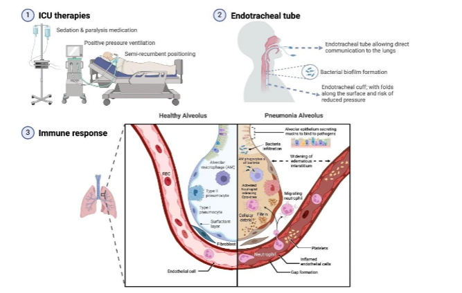 Figure 1 | Mechanisms of ventilator-acquired pneumonia. 1 External factors associated with ICU therapies include mechanical ventilation, sedation and paralysis agents and semi-recumbent positioning; 2 Endotracheal tube prevents glottis closure and provides direct communication to the lungs, allowing microaspiration of secretions from the nasal sinuses and oropharynx. The endotracheal cuff is at risk of deflation, movement and small folds, allowing pooled secretions to leak. Bacterial biofilm can form around the endotracheal tube, which can then become dislodged by movement or suctioning; 3 Inflammatory response lead to inflamed, edematous and infected alveoli. Abbreviations: ICU = intensive care unit; AM = alveolar macrophages.