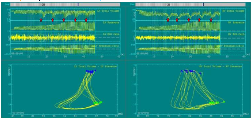 Left (LV) and right (RV) ventricular pressure-volume loops and channels at the beginning of CPR. Markers indicate positive pressure ventilation delivery and its effect of intraventricular volume.