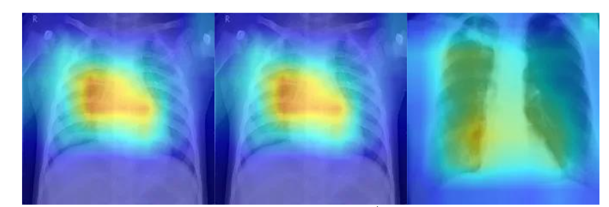 Figure 7: Grad-CAM heatmaps overlaid on chest X-ray images. Red/yellow regions indicate areas with the highest contribution to the model’s prediction, while blue regions are less influential. These visualizations demonstrate that the model tends to focus on radiologically relevant structures, particularly lung opacities and cavitations, when identifying pneumonia and tuberculosis. The consistency of these highlighted regions with known pathological findings suggests that the model’s predictions are grounded in clinically interpretable features. Grad-CAM thus serves not only as a validation tool for researchers but also as an interpretability bridge for clinicians, increasing confidence and transparency in AI-assisted diagnostic systems.