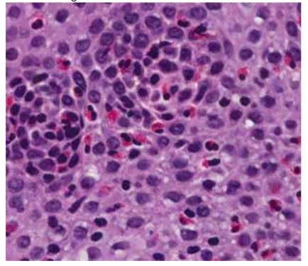 Figure 1. Epitelio esofágico con numerosos eosinófilos. HE X20. Imagen cedida por la Drª L González López. Servicio de A. Patológica del HGU.C Real