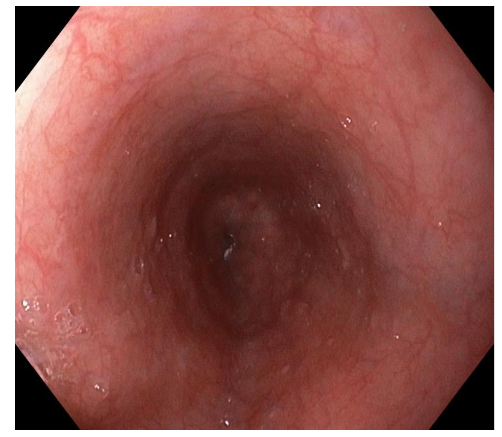Figure 3. Normal endoscopic image of a patient with eosinophilic esophagitis in remission, after treatment with swallowed topical corticosteroids.