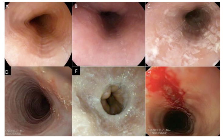 Figure 2. Typical endoscopic images of the mucosa in eosinophilic esophagitis. A: Linear grooves. B: Mucosal edema. C: Microexudates. D: Pseudorings. F: Stenosis. G: Mucosal fragility. A, B and C: Inflammatory phenotype. D and F: Fibrostenotic phenotype.