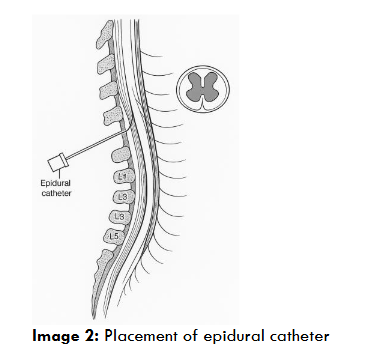 Image 2: Placement of epidural catheter