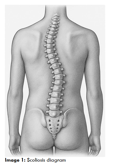 Scoliosis diagram