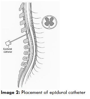 Placement of epidural catheter