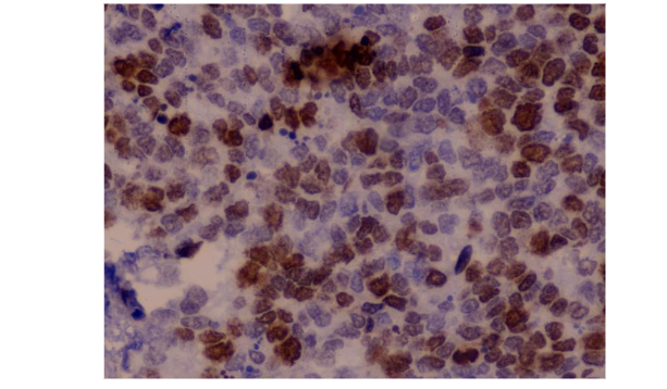Figure 2: Representative immunohistochemical staining for Ki-67 expression in cervical intraepithelial neoplasia (CIN) lesions.