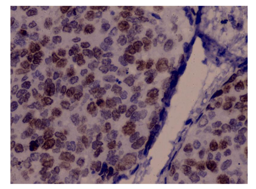 Figure 4: Representative immunohistochemical staining for p53 expression in cervical intraepithelial neoplasia (CIN) lesions.