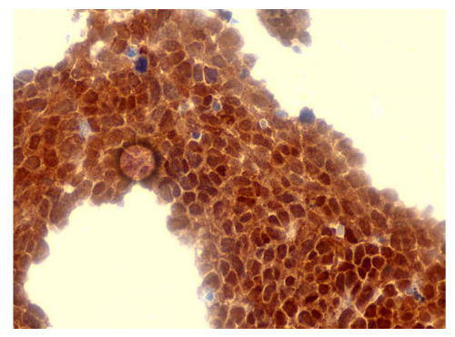 Figure 6: Representative immunohistochemical staining for p16 expression in cervical intraepithelial neoplasia (CIN) lesions.