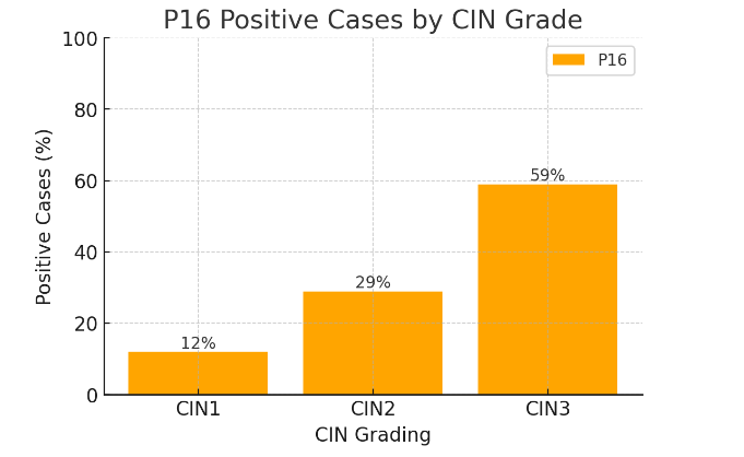 Figure 5: Bar chart showing the percentage of P16 positive cases across different CIN grades (CIN1, CIN2, CIN3). P16 expression compared in patients with CIN1 vs CIN2 and CIN2 vs CIN3. p<0.0001 in both cases.