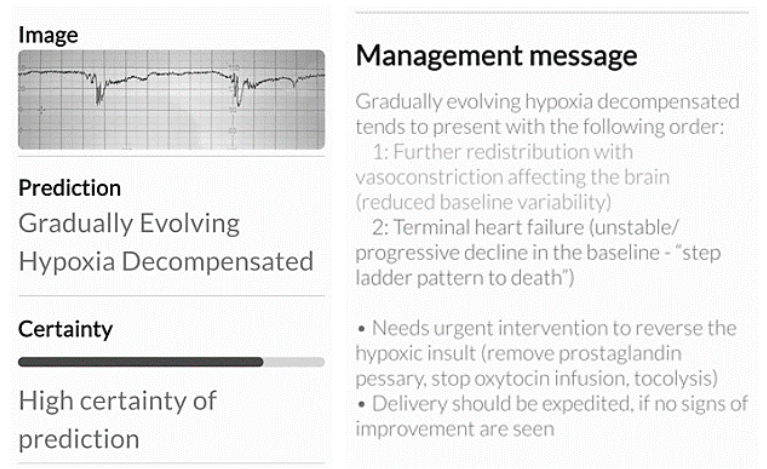 Figure 1. CTG trace classified as 'chronic hypoxia' by the expert, was classified as a 'decompensated gradually evolving hypoxia' by the Tweris Mini CTG AI App. Note the management message is similar to the expert's management plan.