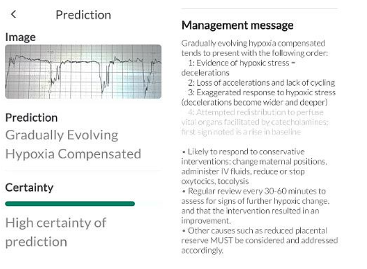 Figure 2. CTG trace diagnosed as 'subacute hypoxia' by the expert was classified as 'decompensated gradually evolving hypoxia' by the Tweris Mini CTG AI App. However, the management message is similar to the expert's management plan.