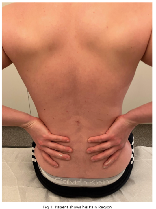 Fig 1: Patient's back showing injection sites.