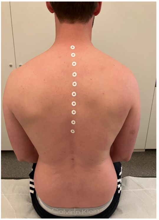 Fig 2: Ten SC Injections were applied on the Midline Fascia in the Origin Region.