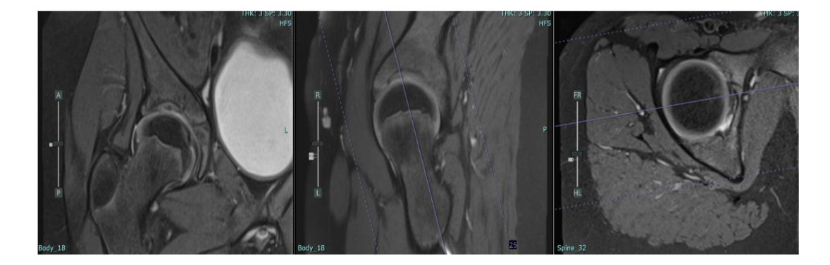 Figure 3: exhibits an MRI scan of the right hip, indicating the resolution of edema and the normal appearance of the femoral head.
