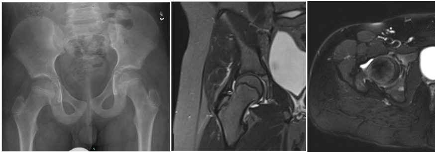 The image displays radiographs of both hips, revealing no abnormalities. Additionally, an MRI of the pelvis showed a normal appearance of the femoral heads.