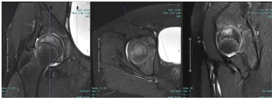 Figure 2: displays an MRI scan of the right hip, indicating the presence of edema in the femoral head while maintaining the normal height of the femoral head.