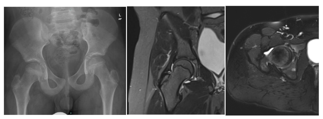 The image displays radiographs of both hips, revealing no abnormalities. Additionally, an MRI of the pelvis showed a normal appearance of the femoral heads.