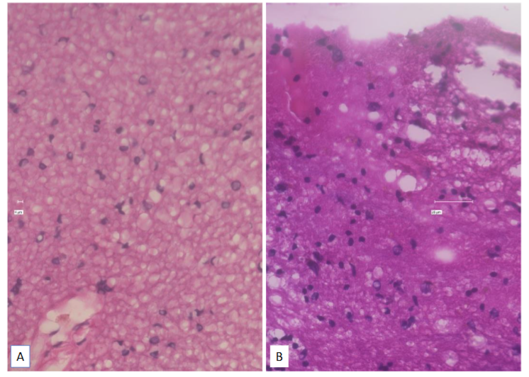 Figure 4: Brain with Multiple Sclerosis (Panel A. Left) and Normal Brain (Panel B. Right) Hematoxylin and Eosin.