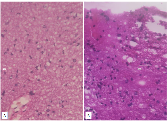 Legend to Figure 4. Brain with Multiple Sclerosis (Panel A. Left) and Normal Brain (Panel B. Right) Hematoxylin and Eosin.