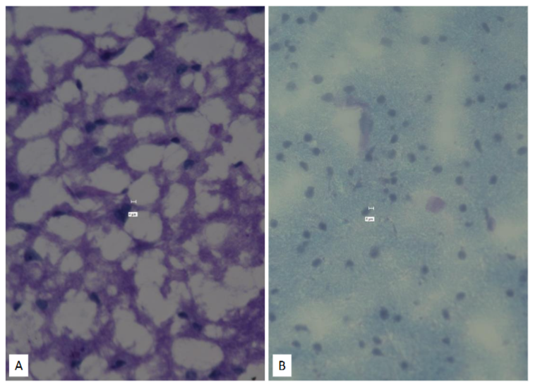 Figure 5: MS (Panel A; Left Panel) and Normal brain (Panel B; Right) Luxol Fast Blue stain.
