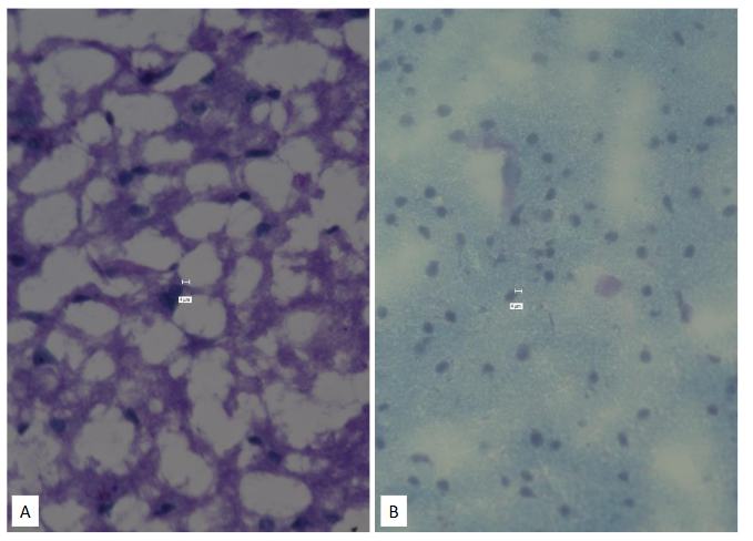 Legend to Figure 5. MS (Panel A; Left Panel) and Normal brain (Panel B; Right) Luxol Fast Blue stain.