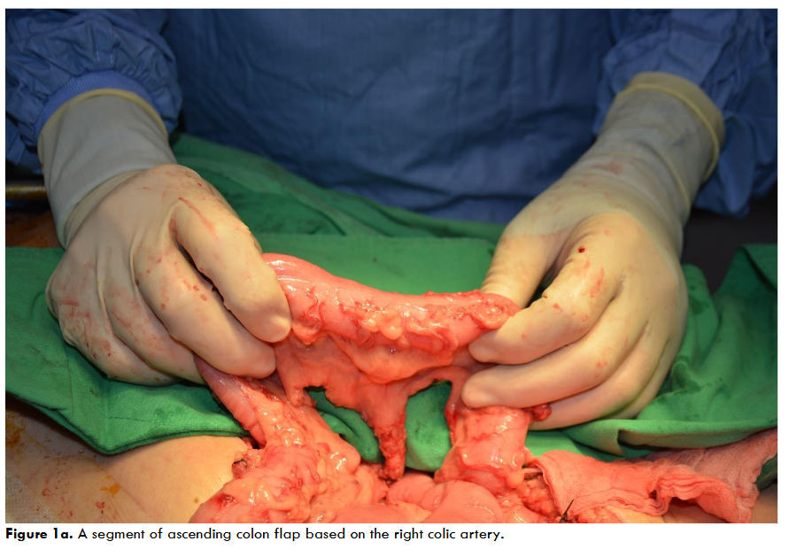 A segment of ascending colon flap based on the right colic artery.