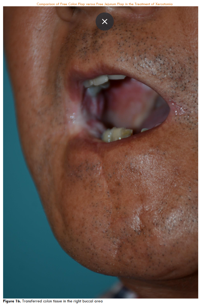 Transferred colon tissue in the right buccal area.