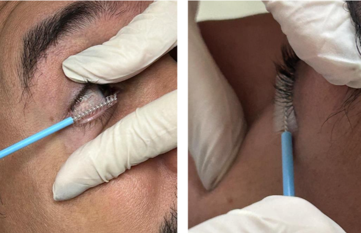 Figure 1 - Conjunctival Mucosa Sampling Procedure.