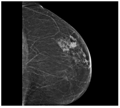 Figure 1a. Breast mammography at relapse