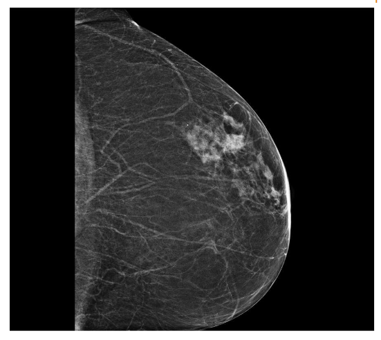 Figure 1a. Breast mammography at relapse