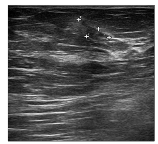 Figure 2. Breast ultrasound after 1 month of gilteritinib (diameter 11 mm x 5 mm)