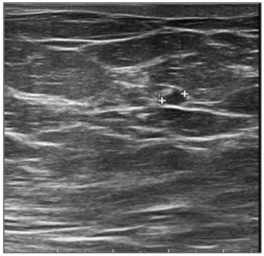 Figure 3. Breast ultrasound after 4 months of gilteritinib (no significant detectable lesions).
