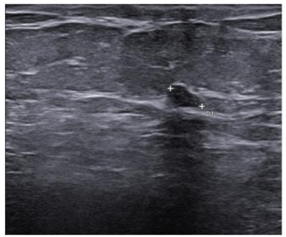 Figure 4. Last breast ultrasound performed, January 2025 (no significant detectable lesions).