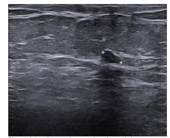 Figure 4. Last breast ultrasound performed, January 2025 (no significant detectable lesions).