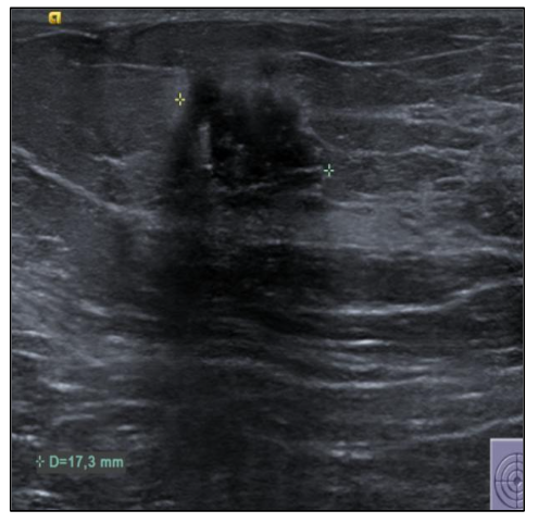 Figure 1b. Breast ultrasound at relapse