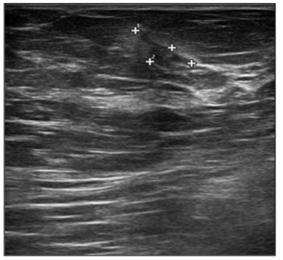 Figure 2. Breast ultrasound after 1 month of gilteritinib (diameter 11 mm x 5 mm)
