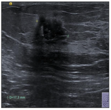 Figure 1b. Breast ultrasound at relapse