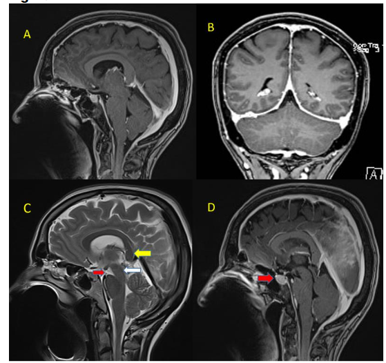 Figure 2A&2B- post contrast T1 weighted Sagittal and coronal images showing engorgement of venous sinuses. Figure 2C- sagittal T2 weighted image showing sagging of mid brain (white arrow), dropping of splenium of corpus callosum (yellow arrow) and reduced mammillo- pontine distance (red arrow). Figure 2D – sagittal contrast enhanced T1 weighted images showing pituitary hyperemia.