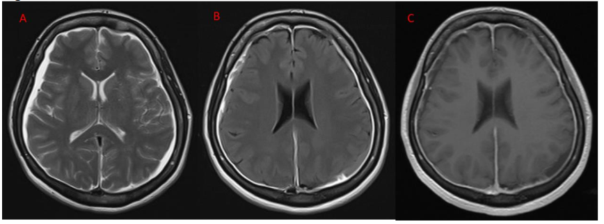 Figure 1A-MRI T2 Axial image showing bilateral subdural effusion, Figure 1 B and 1C-post contrast T2 FLAIR and post contrast T1 weighted images showing diffuse smooth pachymeningeal enhancement