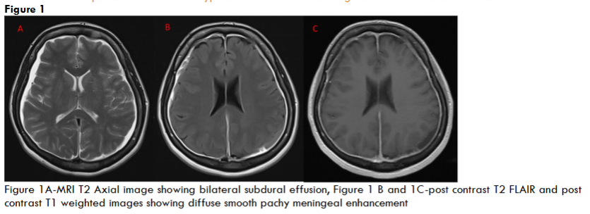Figure 1A-MRI T2 Axial image showing bilateral subdural effusion, Figure 1 B and 1C-post contrast T2 FLAIR and post contrast T1 weighted images showing diffuse smooth pachymeningeal enhancement