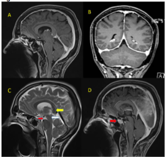 Figure 2A&2B- post contrast T1 weighted Sagittal and coronal images showing engorgement of venous sinuses. Figure 2C- sagittal T2 weighted image showing sagging of midbrain (white arrow), dropping of splenium of corpus callosum (yellow arrow) and reduced mammillo-pontine distance (red arrow). Figure 2D – sagittal contrast enhanced T1 weighted images showing pituitary hyperemia.