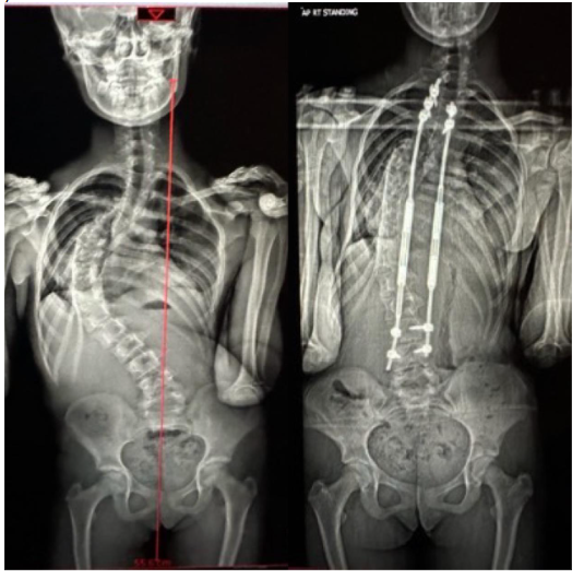 Figure 1: Whole spine EOS images of a patient in the study pre-operatively, and at 2 years post-op. Left image shows pre-op Whole spine Xray with Central Sacral Vertical Line (CSVL, red line showing coronally decompensated curve) with a right sided idiopathic major thoracic curve in a pre-pubertal patient. Right image showing proximal and distal anchors with MCGR rods in situ and a well balanced, corrected curve at 2 years.