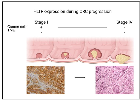 Figure 1. HLTF-immunostaining in well differentiated CRC cells of an adenocarcinoma that began as a polyp with no lymphovascular invasion (Stage I). The tumor has HLTF-positive cancer cells and HLTF-negative TME. Primary adenocarcinoma of male cecum with negligible HLTF immunostaining throughout (Stage IV) was classified with the Tumor, Node, Metastasis system as T4aN2bM1. The primary tumor invaded through the muscularis propria and penetrated to the surface of the visceral peritoneum (T4a). Metastasis was found in 19/27 lymph nodes (N2b) that extended to liver, lung, and omentum (M1). Made with BioRender.